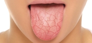 Dry Mouth
