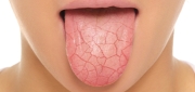 Dry Mouth