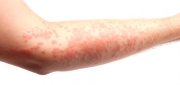 Eczema & Psoriasis