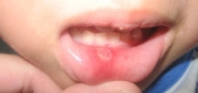 Mouth Ulcers