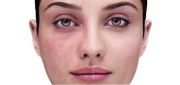 Rosacea Treatment