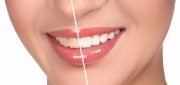 Teeth Whitening