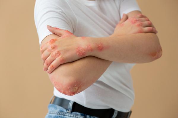 Understanding Psoriasis: Triggers and Strategies for Management